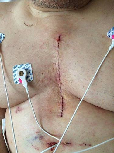 Invasive surgery for aneurysm/heart rebuild / Headline Surfer